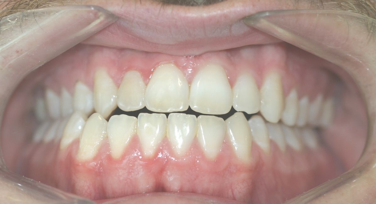Before and after orthodontic treatment