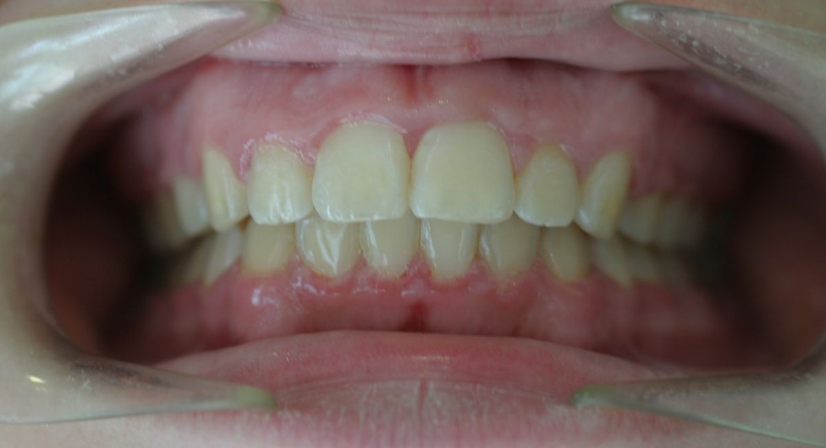 Before and after orthodontic treatment