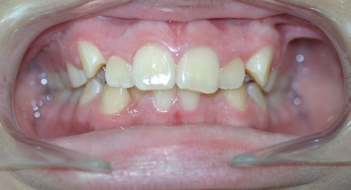 Before and after orthodontic treatment