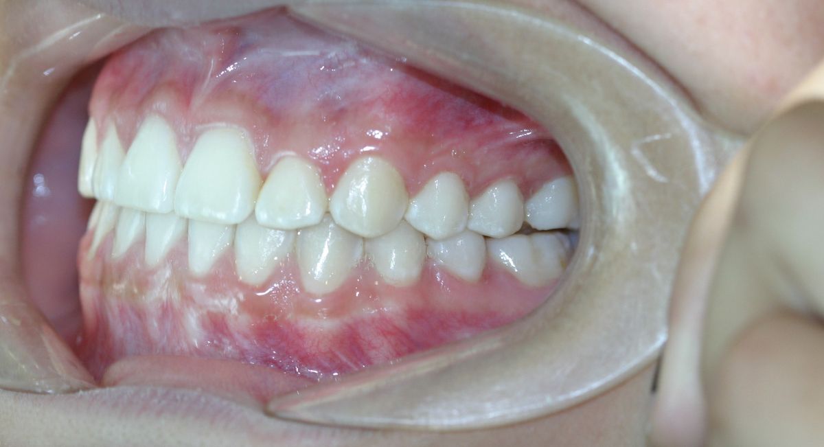 Before and after orthodontic treatment
