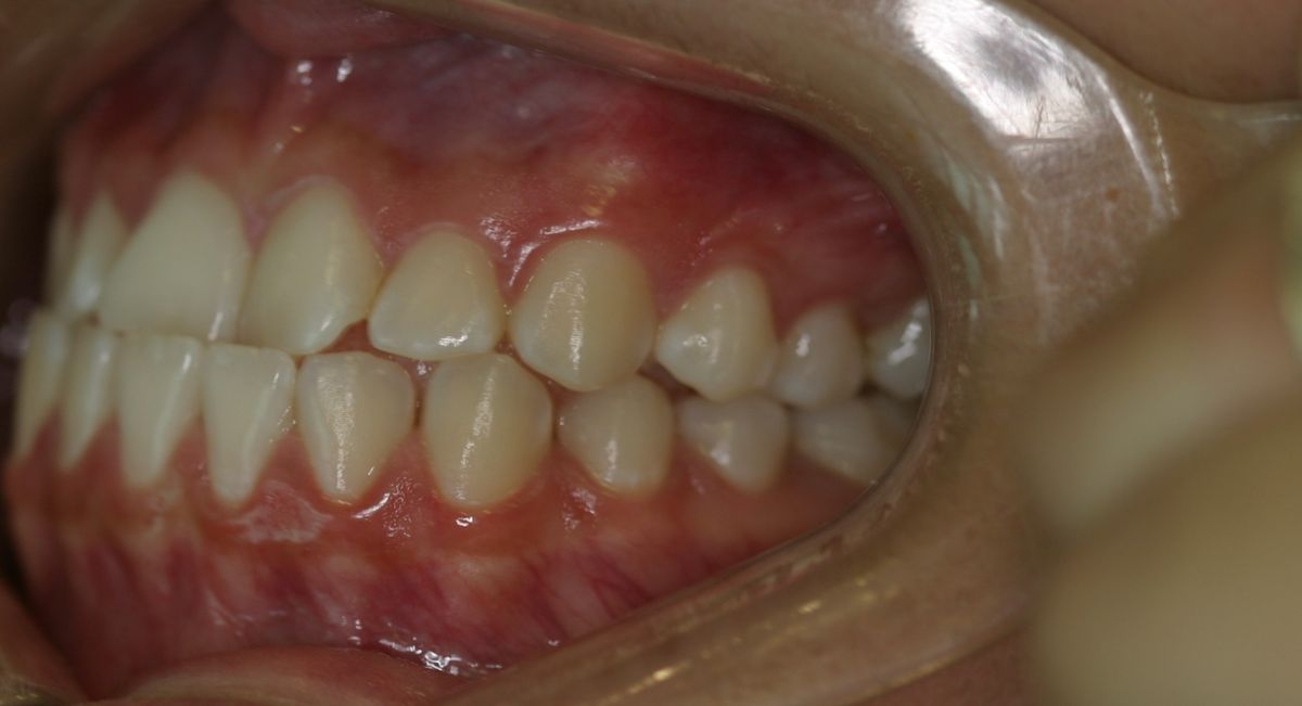 Before and after orthodontic treatment