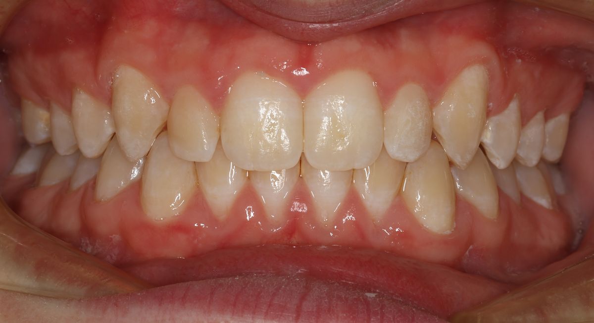 Before and after orthodontic treatment