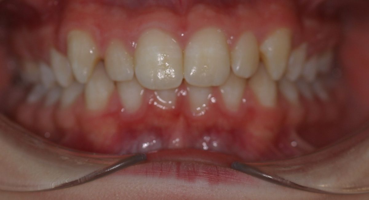 Before and after orthodontic treatment