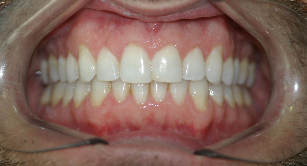 Before and after orthodontic treatment