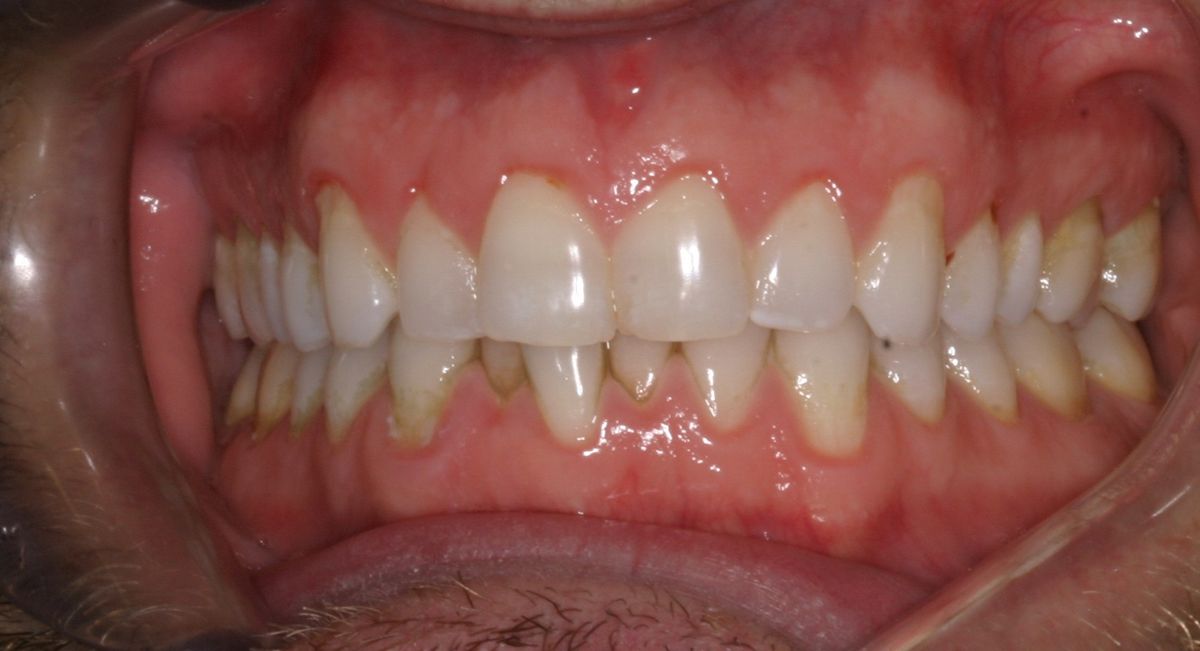Before and after orthodontic treatment