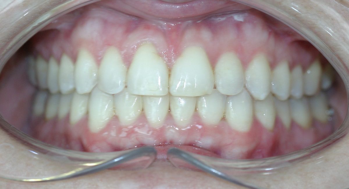 Before and after orthodontic treatment