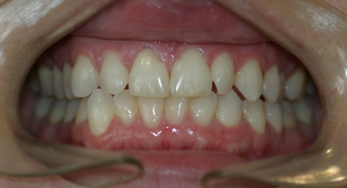 Before and after orthodontic treatment