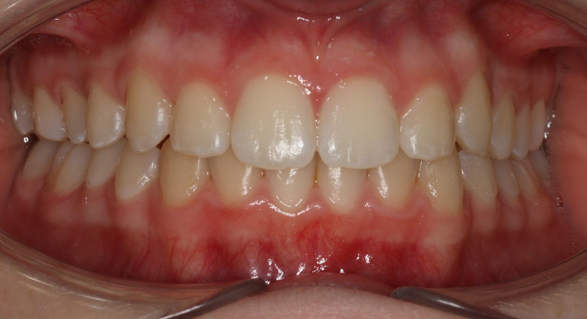 Before and after orthodontic treatment