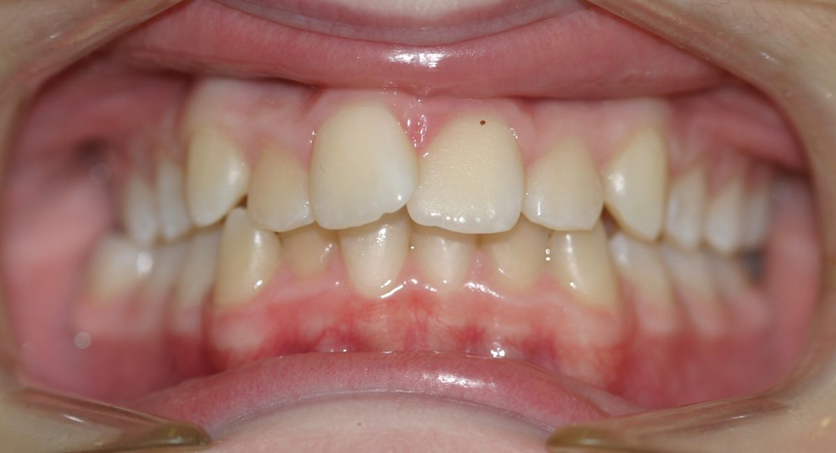 Before and after orthodontic treatment
