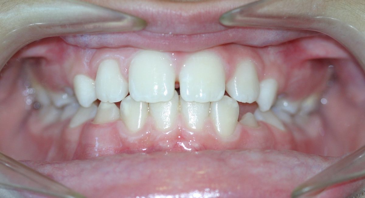 Before and after orthodontic treatment