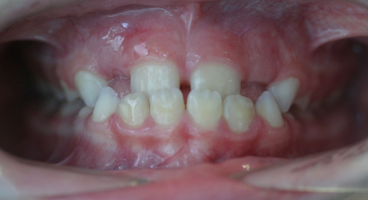Before and after orthodontic treatment