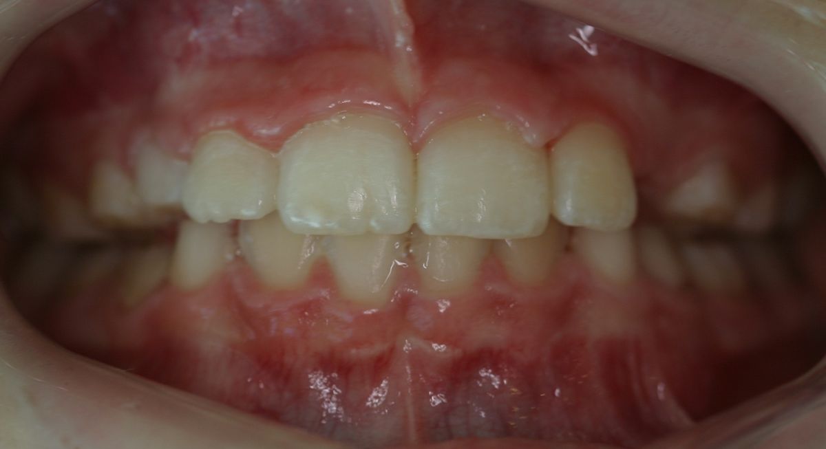 Before and after orthodontic treatment