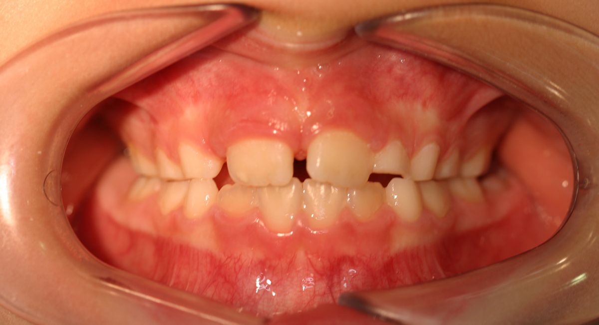 Before and after orthodontic treatment