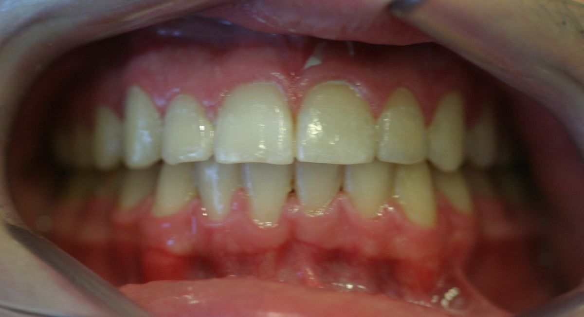 Before and after orthodontic treatment