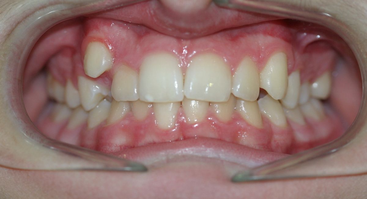 Before and after orthodontic treatment