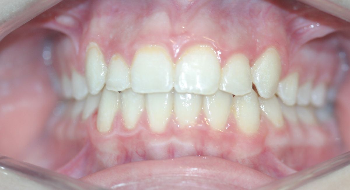 Before and after orthodontic treatment