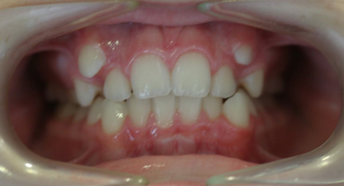 Before and after orthodontic treatment