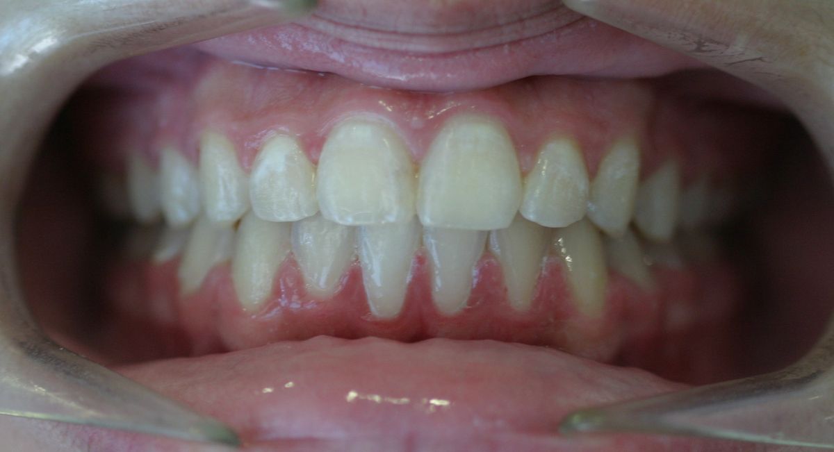 Before and after orthodontic treatment