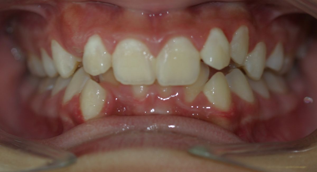 Before and after orthodontic treatment