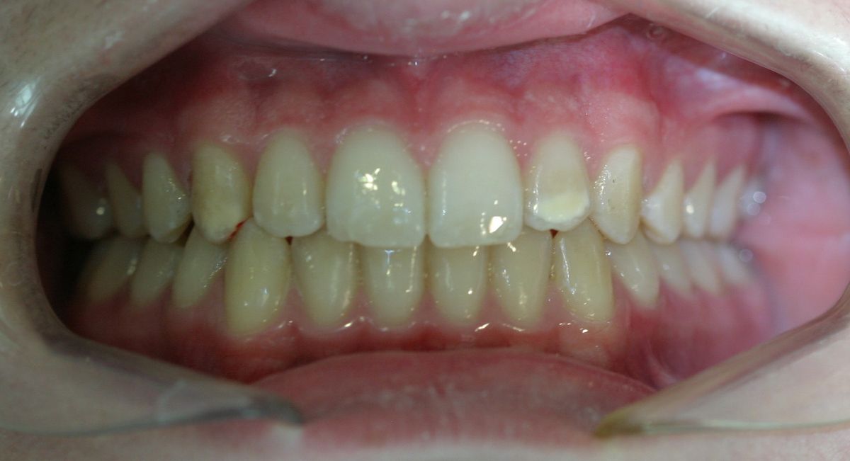 Before and after orthodontic treatment