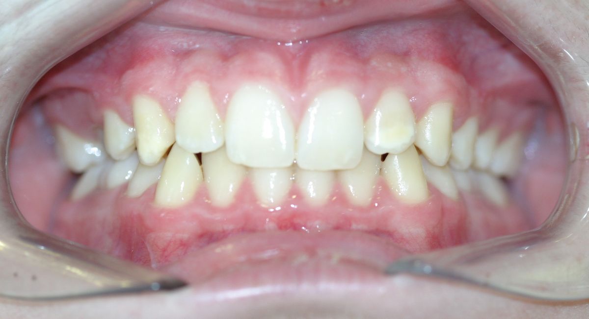 Before and after orthodontic treatment