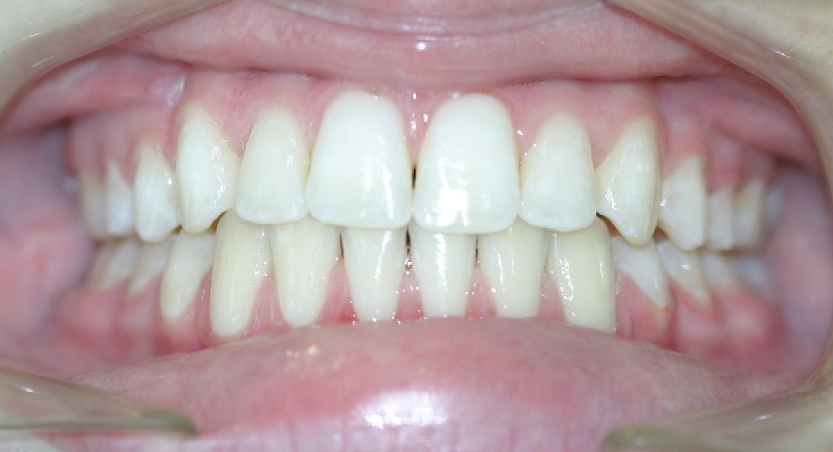 Before and after orthodontic treatment