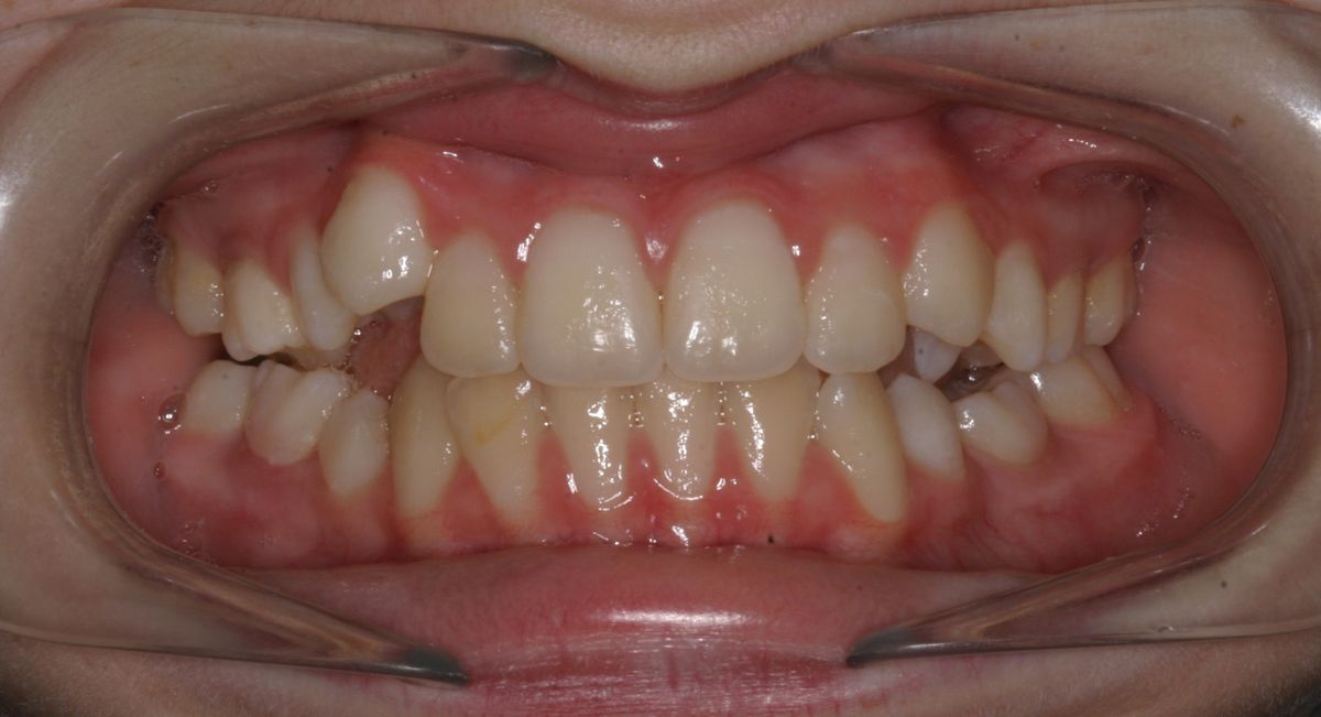 Before and after orthodontic treatment