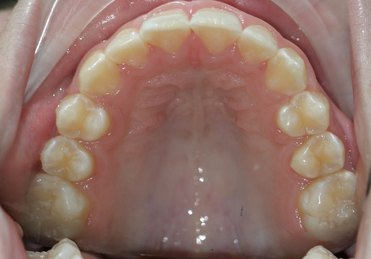 Before and after orthodontic treatment