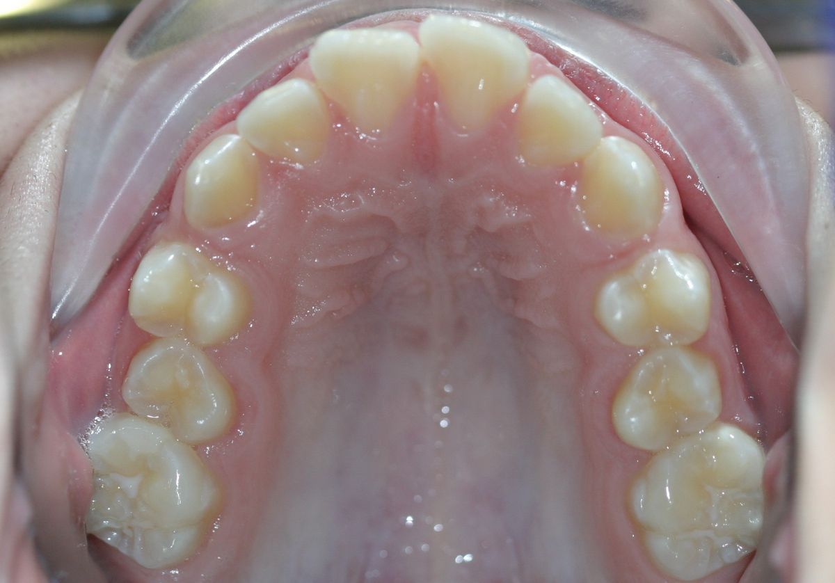 Before and after orthodontic treatment