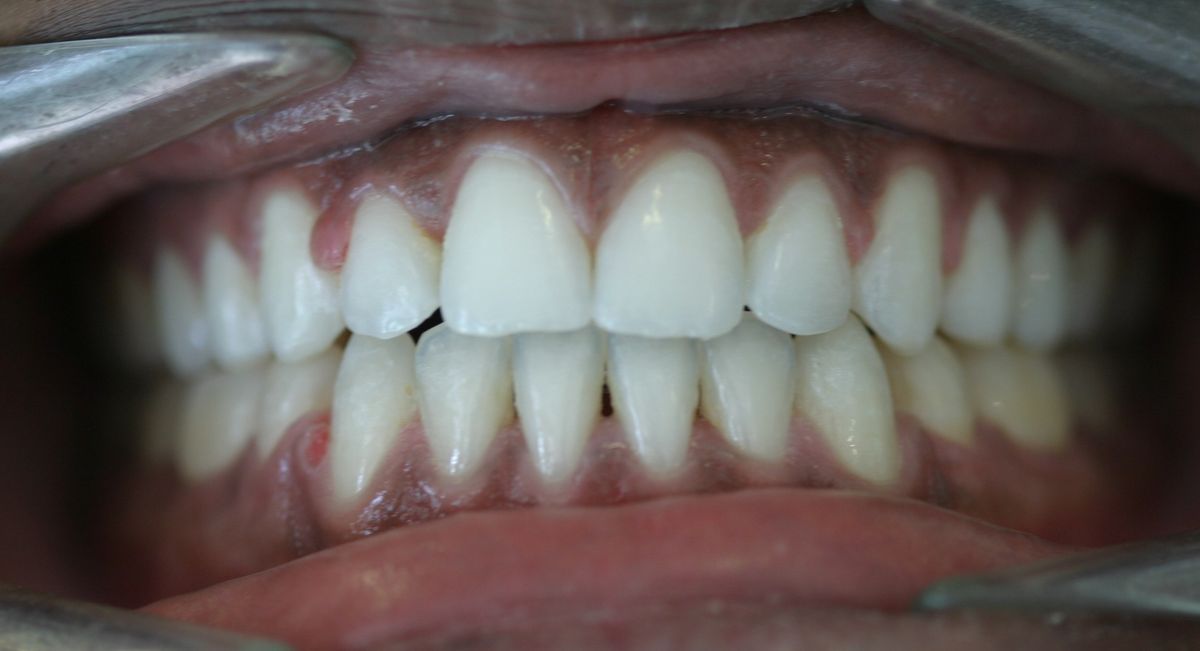 Before and after orthodontic treatment