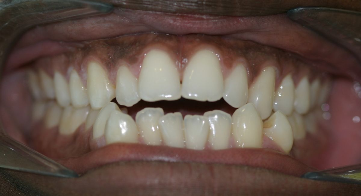 Before and after orthodontic treatment
