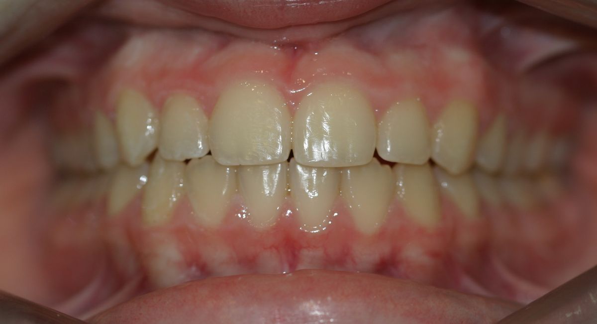 Before and after orthodontic treatment