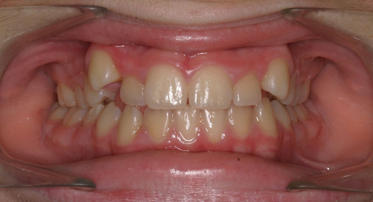 Before and after orthodontic treatment