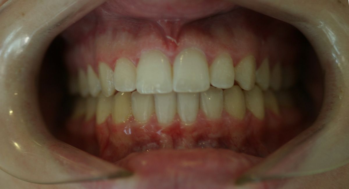 Before and after orthodontic treatment