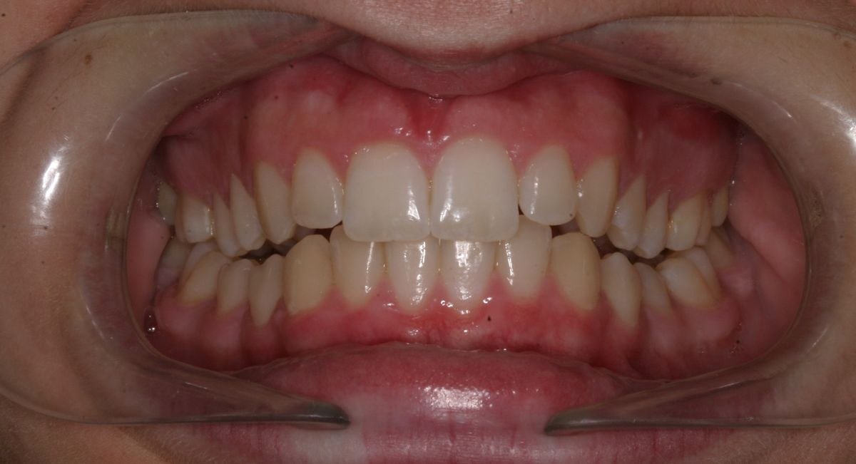Before and after orthodontic treatment