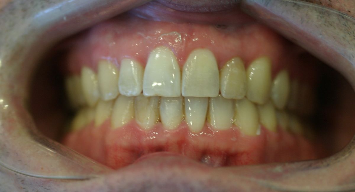Before and after orthodontic treatment