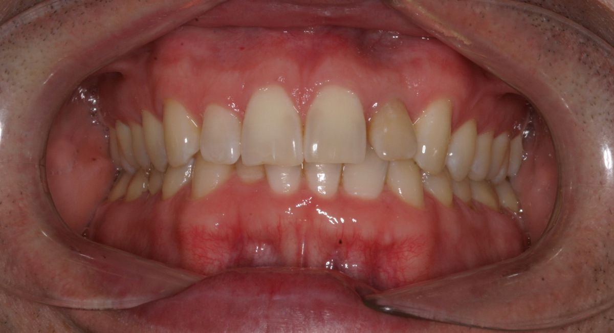 Before and after orthodontic treatment
