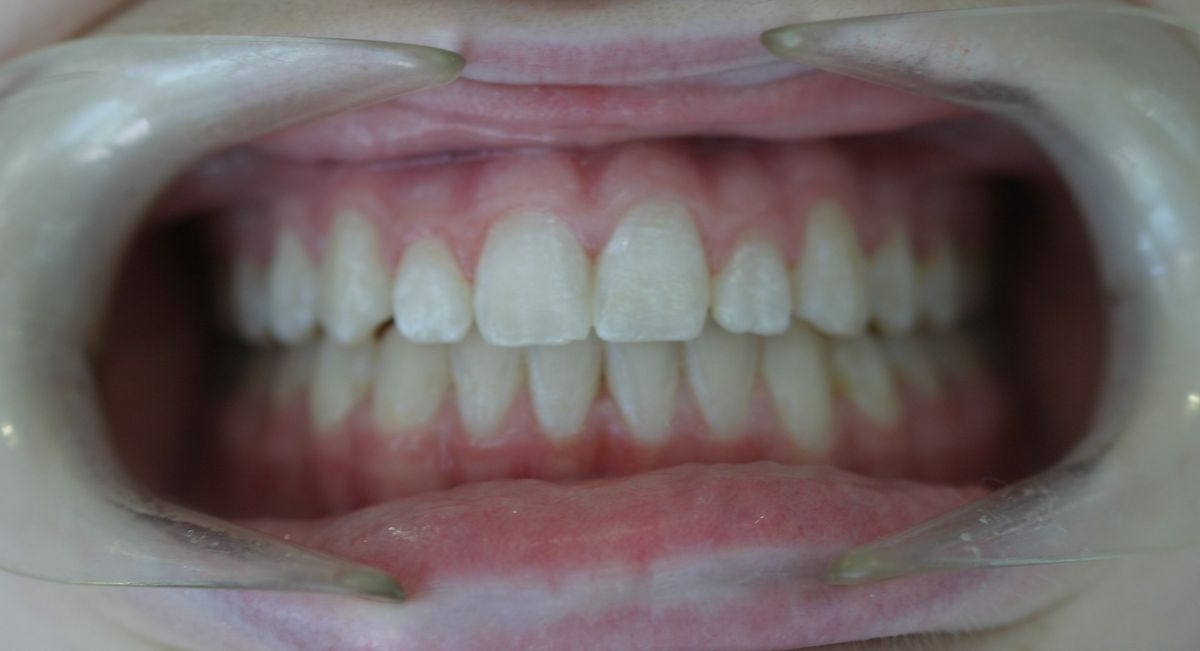 Before and after orthodontic treatment
