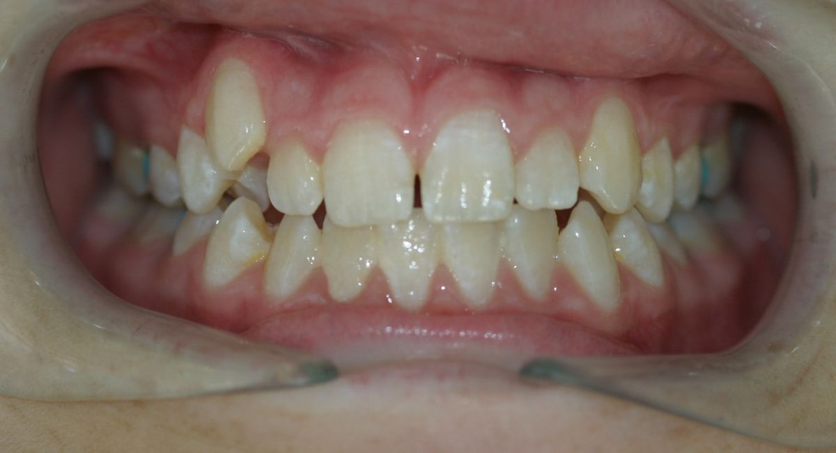 Before and after orthodontic treatment