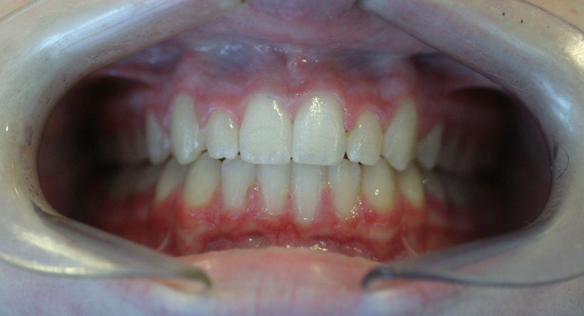 Before and after orthodontic treatment