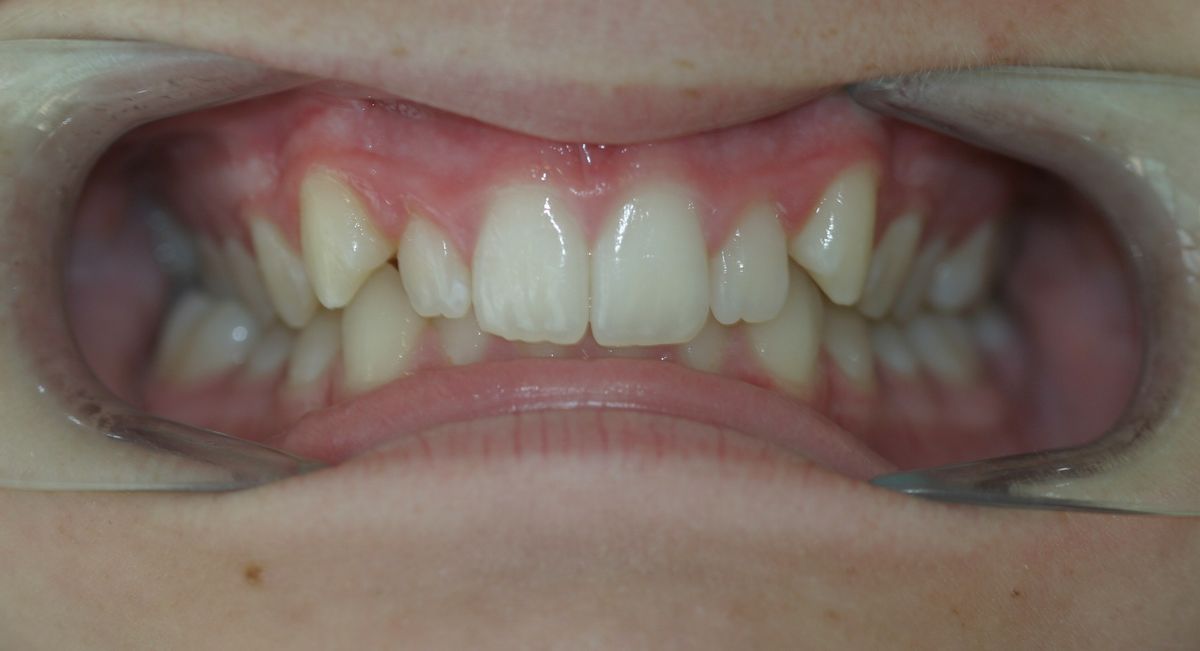 Before and after orthodontic treatment