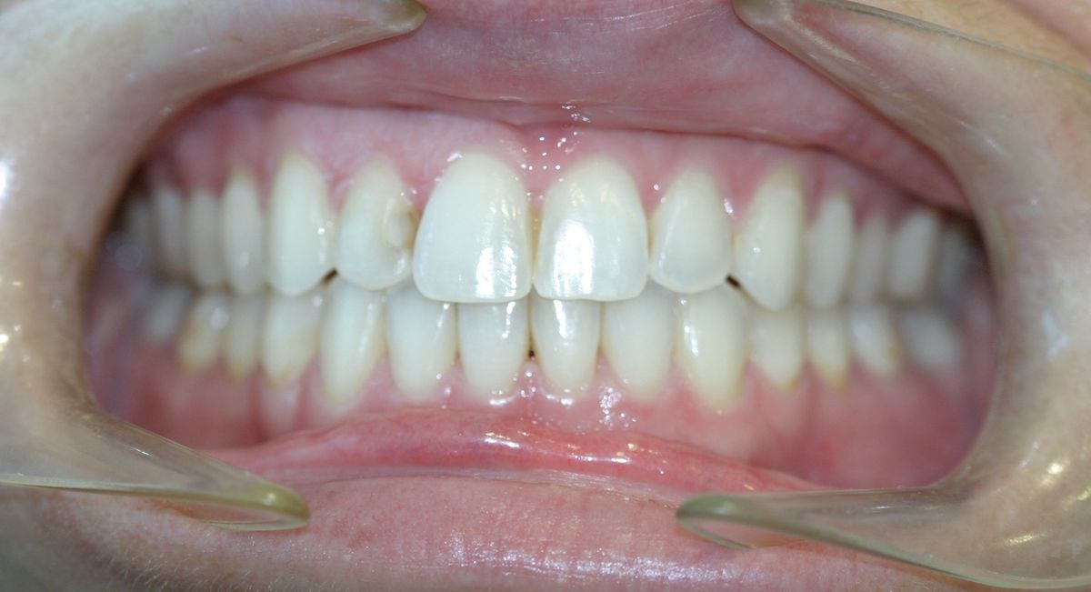 Before and after orthodontic treatment