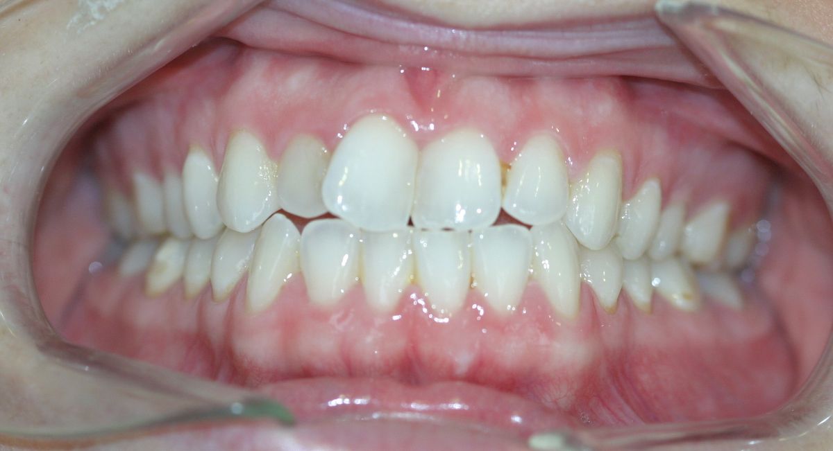 Before and after orthodontic treatment