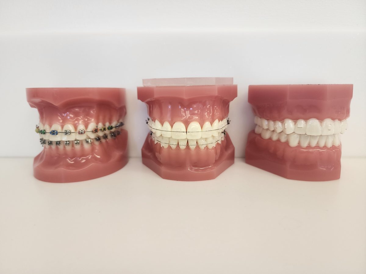 Three dental models on a counter showing metal braces, clear aligners and clear braces side by side