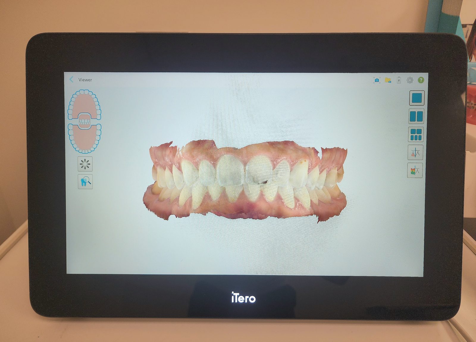 A digital scan of a bite on the chairside screen, where an aligner plan begins